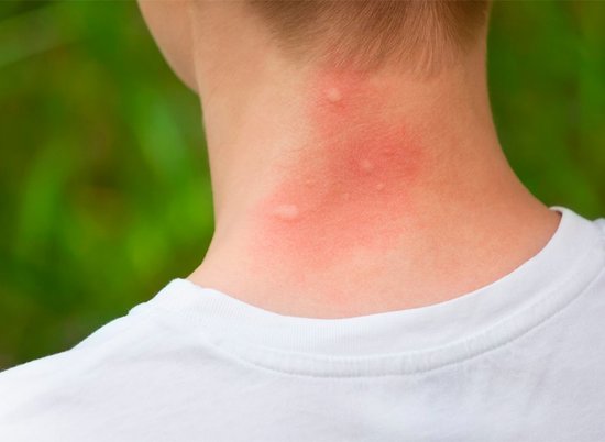 Волгоградцы узнали, как быстро снять зуд от комариного укуса