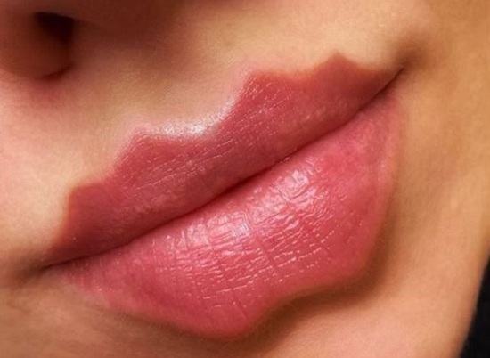 Выглядит ужасно: косметолог оценила новый тренд на "губы-осьминоги"