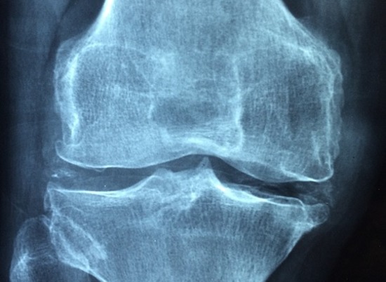 Доктор Мясников рассказал, как уберечь себя от остеопороза