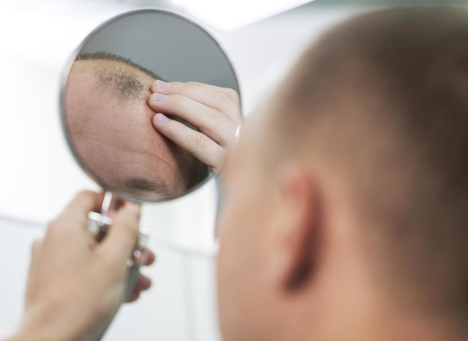 Волгоградцам рассказали о причинах выпадения волос