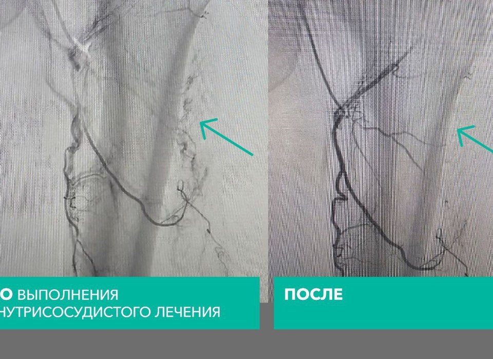 Уникальную операцию ТАХЭ провели пациентке с саркомой в Волгограде